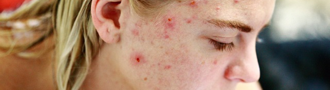 traitement acné